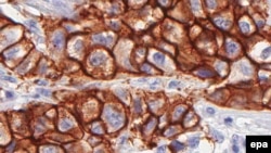 Imagine scanată a unui țesut bolnav de cancer